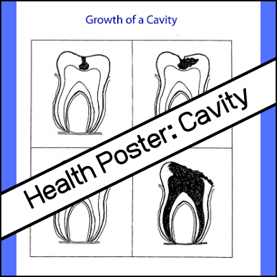 Show students visually how a cavity grows within the tooth with this dental poster. Use when teaching about teeth or dental health.